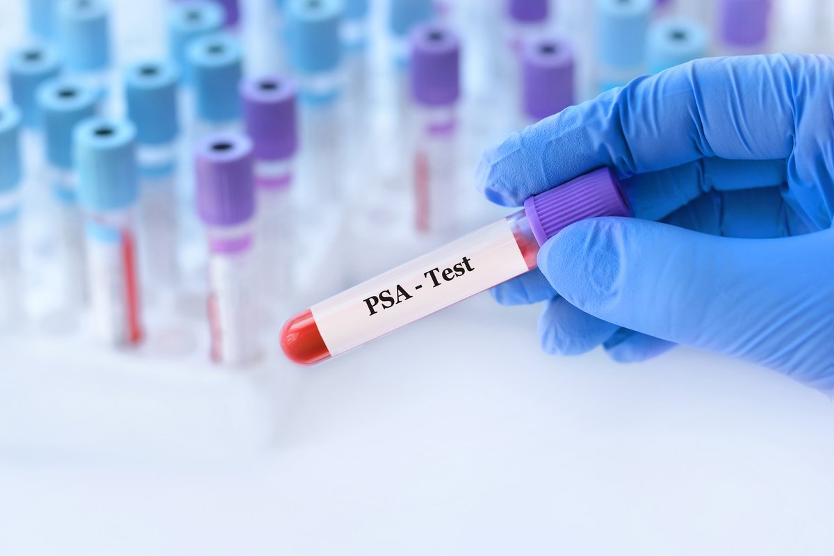 bmj_company's tweet image. Current prostate testing may not target those most likely to benefit, warn experts in a study published in @bmj_latest bit.ly/3KA8wG5

#ProstateCancer #PSAScreening