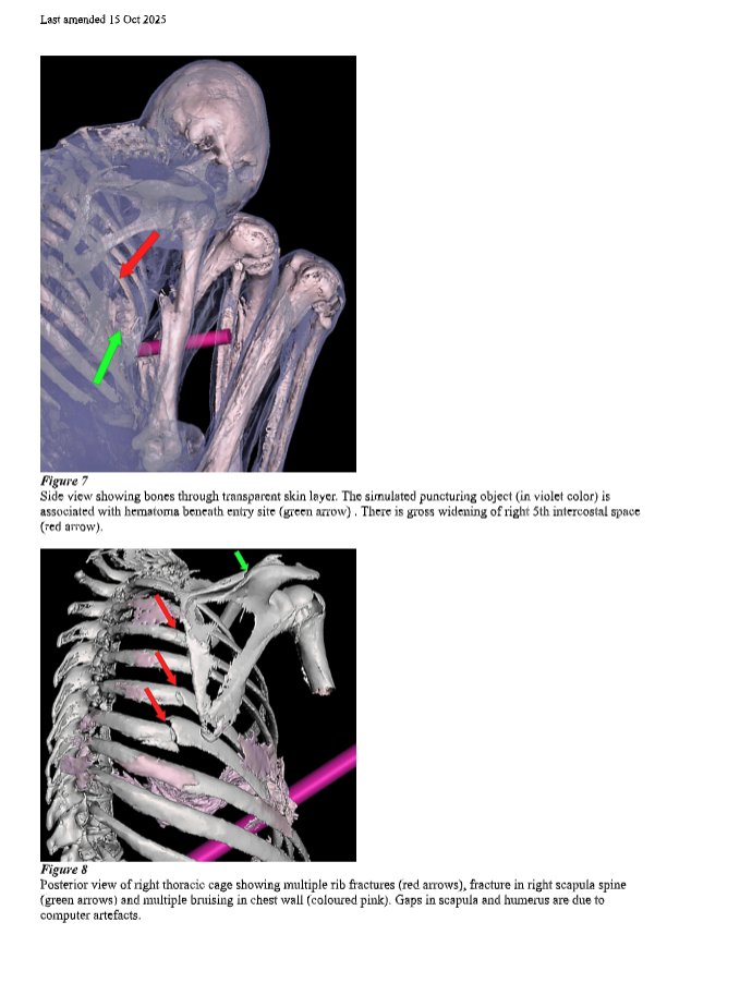 Later today or tomorrow, I will be publishing a 16-page research paper on Tridactyls.org, available in both English and Spanish. The study presents a potential cause of death for Montserrat identified through a virtual autopsy by Dr. Fung, a medical specialist from Hong