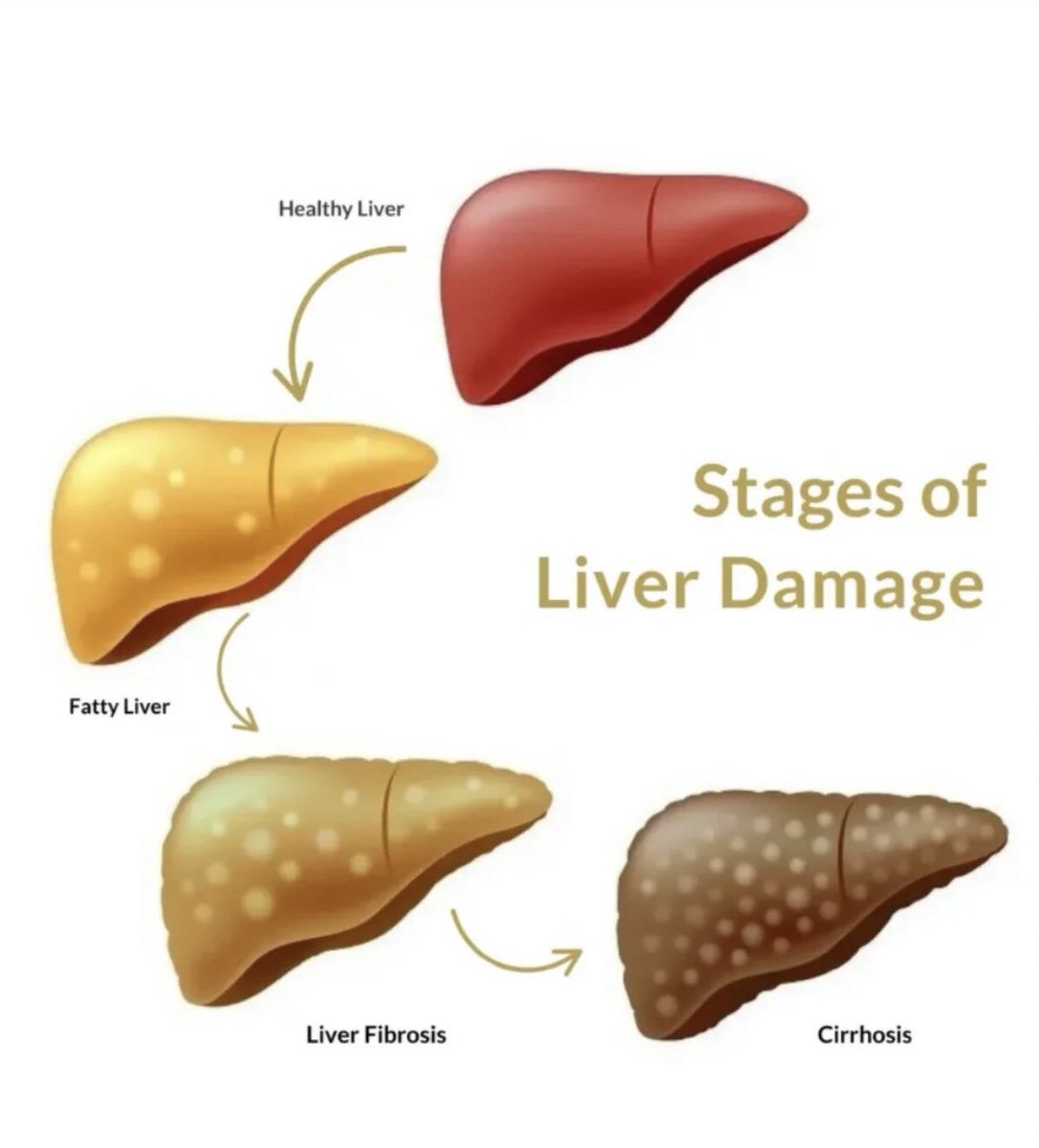 Stages of Liver Damage
Your liver is a silent warrior but it can only take so much.

1️⃣ Healthy Liver
2️⃣ Fatty Liver (reversible with lifestyle changes)
3️⃣ Liver Fibrosis
4️⃣ Cirrhosis (often irreversible)

Protect your liver: eat healthy, and limit alcohol 
#LoveYourW #GraffxGULF