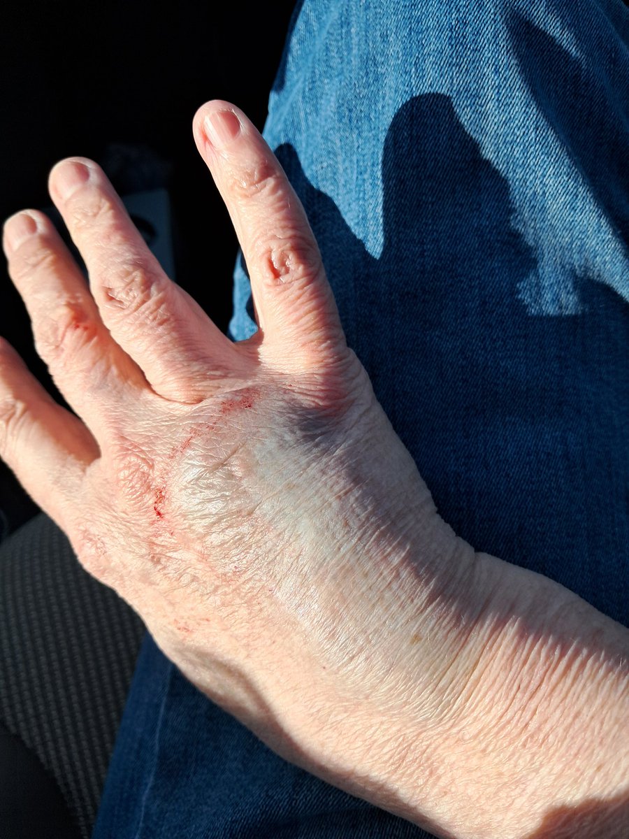 So I go for the CTs and they can't get a vein.  3 different techs, 6 sticks,  and they can't get it.  Finally this guy comes in, sticks the IV in my hand...hurt like hell!!...and gets it.  They start the contrast and my hand blows up like a balloon.   <a href="/LouDPhillips/">Lou Diamond Phillips</a> #theFOLD
