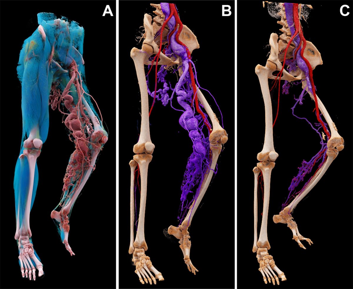 radiology_rsna's tweet image. Pre- and posttreatment images show decreased aberrant vascularity and attenuated arteriovenous dilatation in this week&apos;s Images in Radiology. Check it out here ➡️  bit.ly/47nlzCl