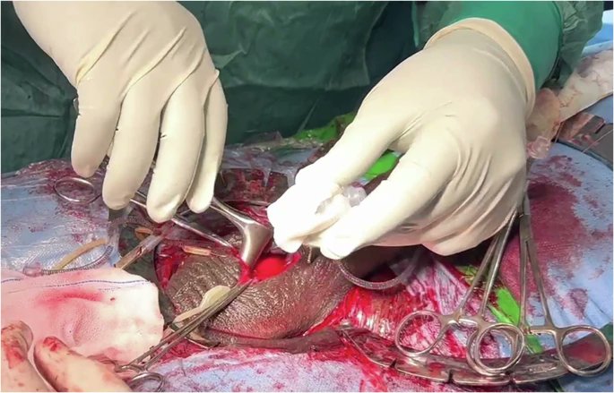 yoursexmedjour's tweet image. Application of gelatin sponge (Gelfoam®) as a hemostatic agent in inflatable #penileprosthesis implantation👉 rdcu.be/eMrnW

@OsamaShaeer @DrAhwany @ragheba @kamal_shaeer