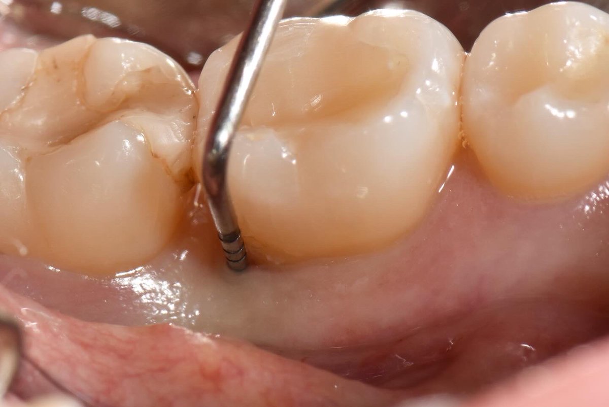 Que complejo es el tratamiento de defectos intraoseos por lingual y que demeritados los tienen muchos clínicos de redes sociales. 

Acaso, aquellas vacas sagradas de la plástica periodontal discriminarán a los pacientes con periodontitis y más si el conflicto es por lingual ?