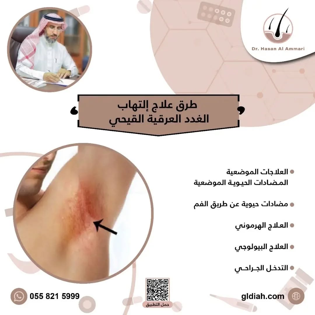 👈طرق علاج إلتهاب الغدد العرقية القيحي 

🔸العلاجات الموضعية / المضادات الحيوية الموضعية
🔸مضادات حيوية عن طريق الفم 
🔸العلاج الهرموني 
🔸العلاج البيولوجي 
🔸التدخل الجراحي
#غدد_عرقية 
#جلدية_تجميل
#جلدية
#السعوديه_العراق