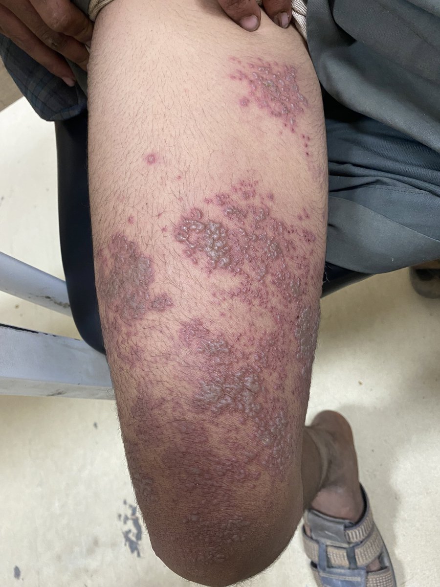 hemo_shk's tweet photo. #Dermatology 

What is the diagnosis?

#MedX #MEDHM 
@IhabFathiSulima https://t.co/jwQGa8h6Xk