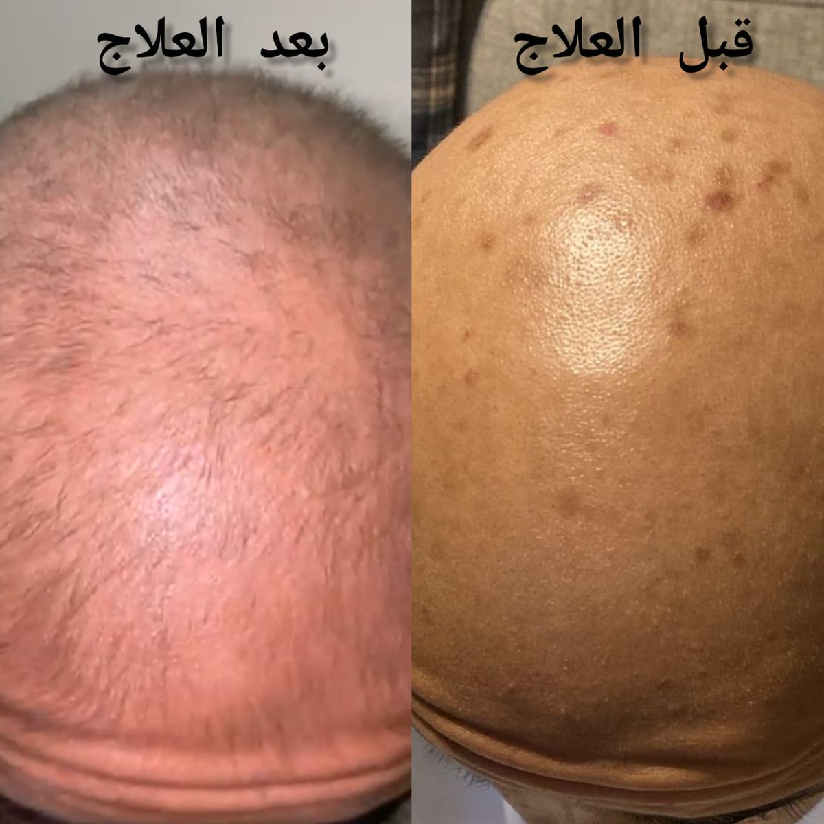 قبل وبعد العلاج 👌
تحت إشراف الدكتور حسن العماري استشاري طب الأسرة والأمراض الجلدية 🌹
.
 
.

#كاريزما76
#أمراض_جلدية
#صلع #صلع_شعر
#صلع_وراثي