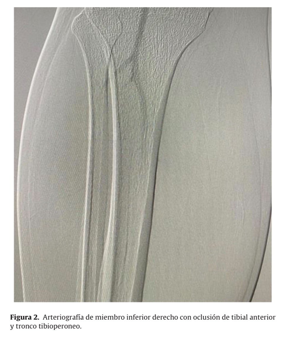 Dr Luis Felipe Cabrera Vargas MD FACS MACC MACCVA (@pipecabrerav) on Twitter photo Very proud of Dr Juan Camilo Gómez for his new publication about acute limb ischemia secondary to psychoactive substance use: role of prostaglandins ⤵️💥👁️! Great team work with our mentor Professor <a href="/LeonardoRandial/">Leonardo Randial</a> ! <a href="/pferrada1/">Paula Ferrada MD FACS FCCM MAMSE</a> <a href="/SWexner/">Steven D Wexner MD, PhD</a> <a href="/TomVargheseJr/">Tom Varghese Jr. MD, MS, MBA, FACS, MAMSE 🇺🇸</a> Very proud of Dr Juan Camilo Gómez for his new publication about acute limb ischemia secondary to psychoactive substance use: role of prostaglandins ⤵️💥👁️! Great team work with our mentor Professor <a href="/LeonardoRandial/">Leonardo Randial</a> ! <a href="/pferrada1/">Paula Ferrada MD FACS FCCM MAMSE</a> <a href="/SWexner/">Steven D Wexner MD, PhD</a> <a href="/TomVargheseJr/">Tom Varghese Jr. MD, MS, MBA, FACS, MAMSE 🇺🇸</a>