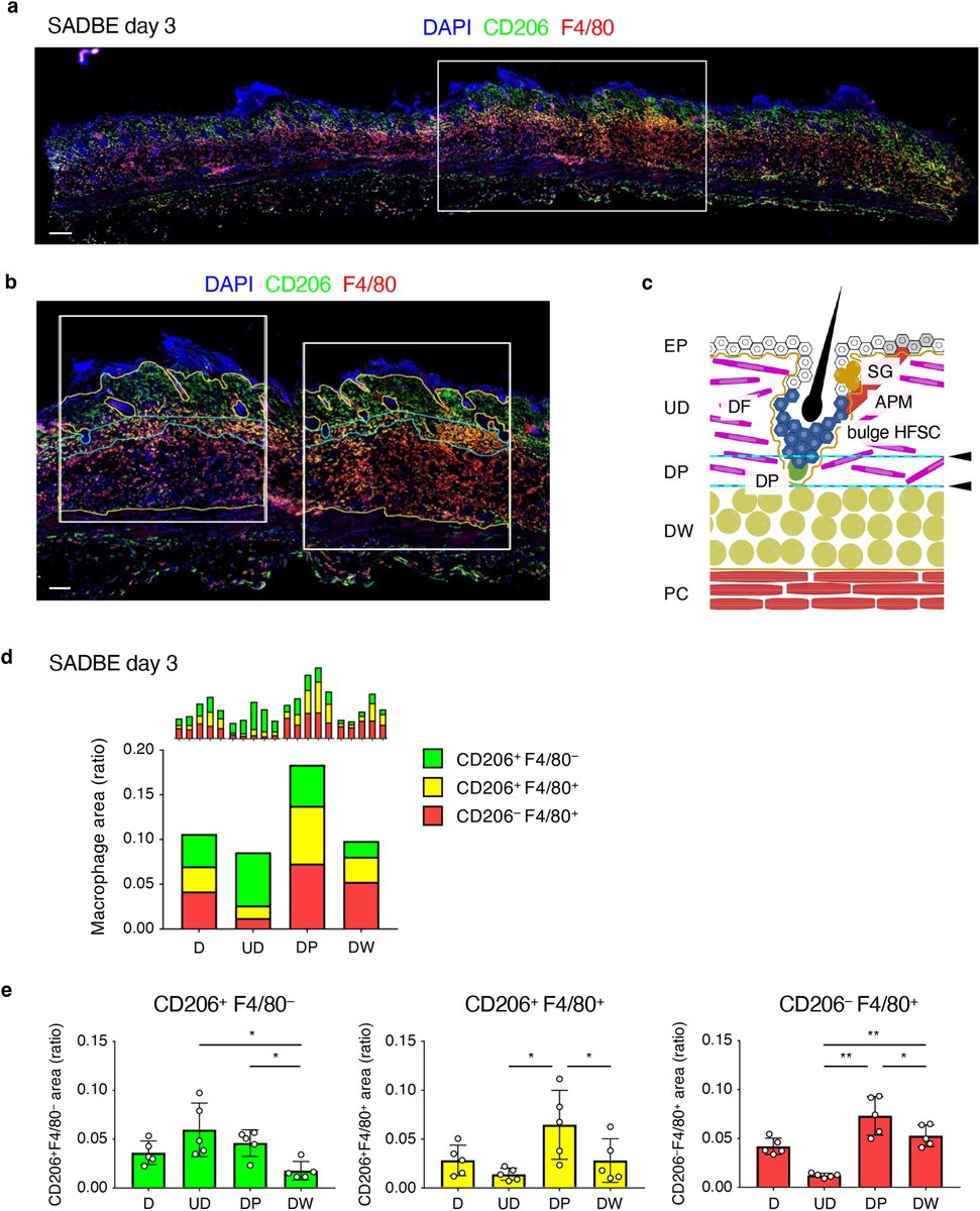 How does squaric acid regrow hair in #alopciaareata? #Macrophages may hold the key ow.ly/5B5u50XggrW #medderm #dermtwitter
