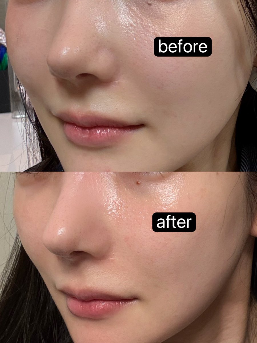 第46回モフィウス プレゼント✨🎁✨
ゆりにゃさん、nouさん激推しの「モフィウス」今回も「ほうれい線」「口横のポニョ」「目の下のクマ」3部位を3名様に無料プレゼント！
応募はこのアカウントフォローしてリポスト、いいねお願いします✨️
忖度なしの施術レポよろしくです！
当選発表は28日お昼🎉