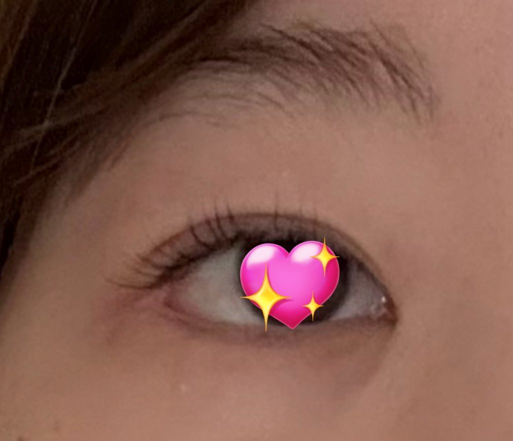 _____naa_oO's tweet photo. テーラーで額挙上を受けて3ヶ月が経過しました！
1ヶ月後の経過がかなり好きだったので、それと比べるとやっぱり見開き感は減っちゃったけど、引き続き二重幅がちゃんと見えているのが好み…このまま安定されて欲しい🥲
← after     before→
 #テーラー美容外科 https://t.co/YKoqt3ps2v