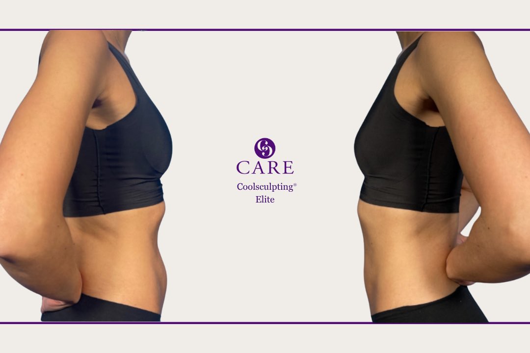 Tomorrow is CoolSculpting® Consult Day at CARE!Come in for a free consultation with our certified CoolSculpting Elite and take advantage of exclusive, one-day-only specials that you won’t want to miss. It is the perfect time start before the holidays!
💜 10:30-2:30 PM