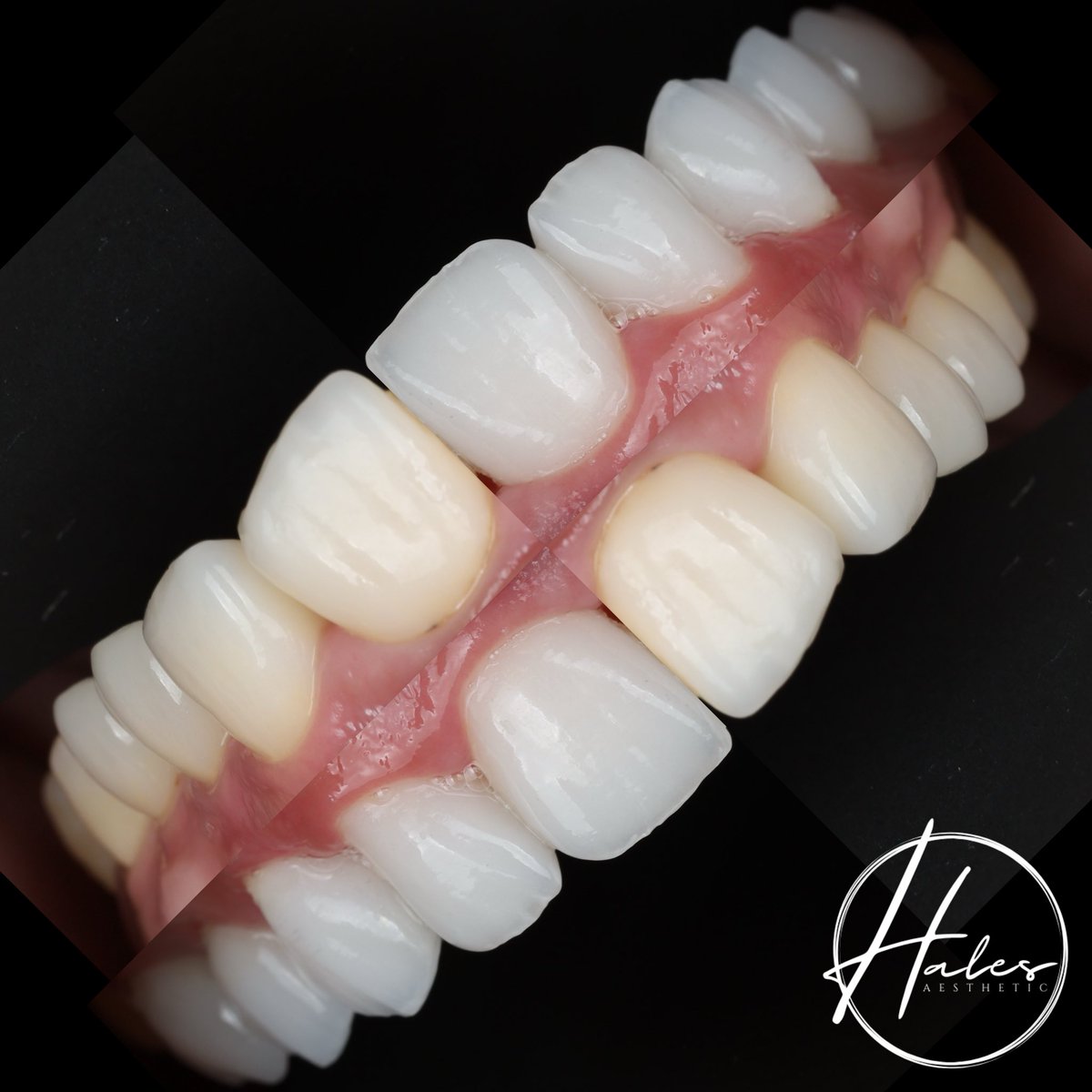 Every smile tells a story — and this one is all about balance, detail, and harmony.

Each curve, each contour, each reflection of light is intentional. Designing veneers isn’t about perfection; it’s about creating a natural flow that complements a person’s face and personality.