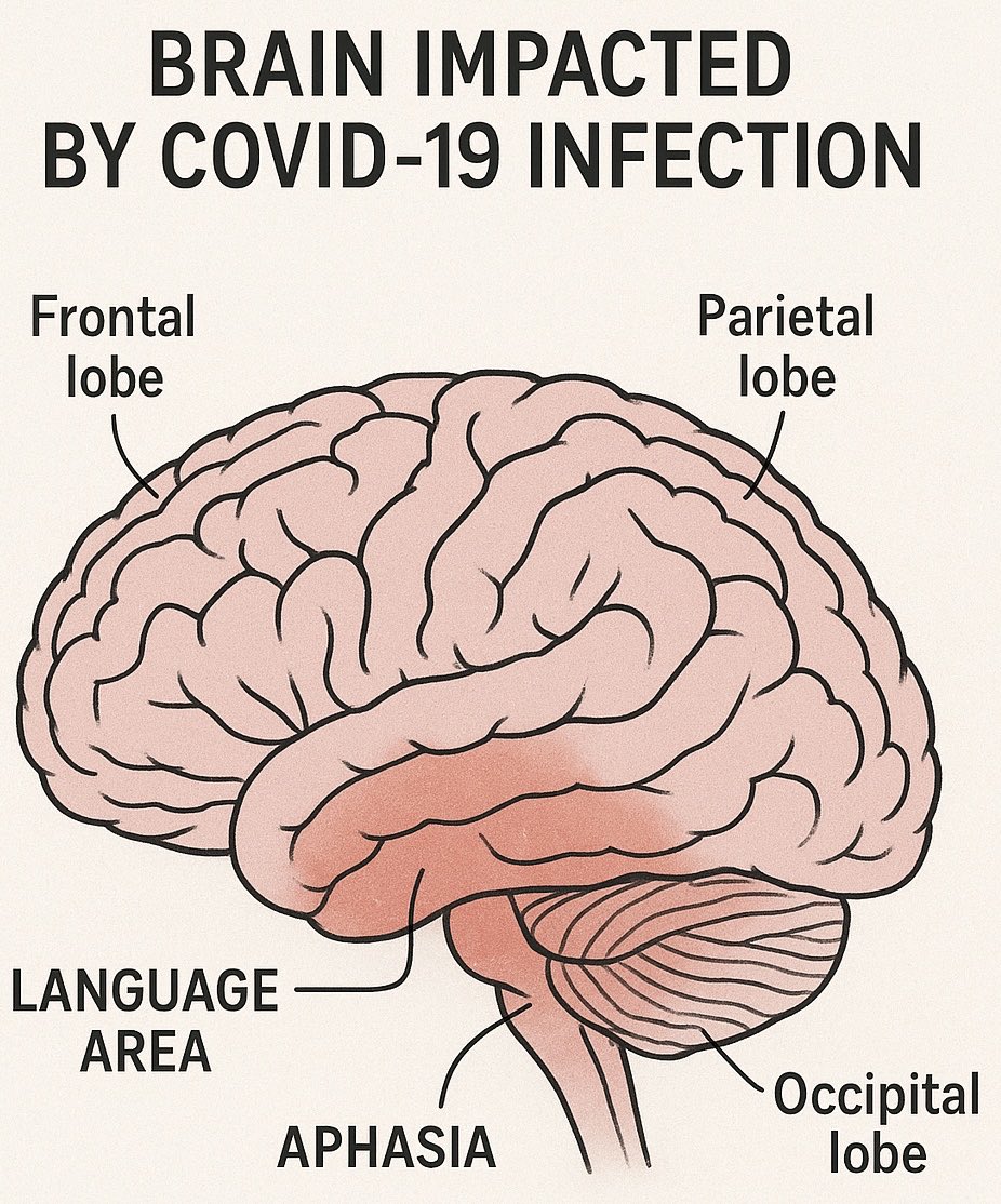 At 57, <a href="/KeithUrban/">Keith Urban</a> did NOT have a ‘senior moment’- he has #LongCovid. Aphasia is an extremely common post covid condition. All it takes is 1 infection &amp; he is exposed repeatedly to this virus. 
•Recent laryngitis: In mid-October 2025, Urban canceled a concert in South Carolina