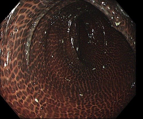 nora ౨ৎ (@seap3arl) on Twitter photo healthy colon VS colon after lax abuse (melanosis coli) healthy colon VS colon after lax abuse (melanosis coli)