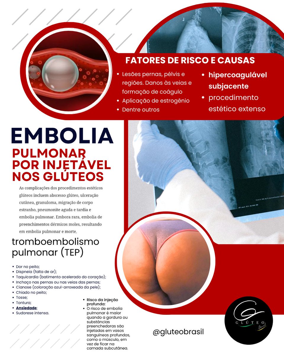 Injetáveis estéticos nos Glúteos @gluteobrasil