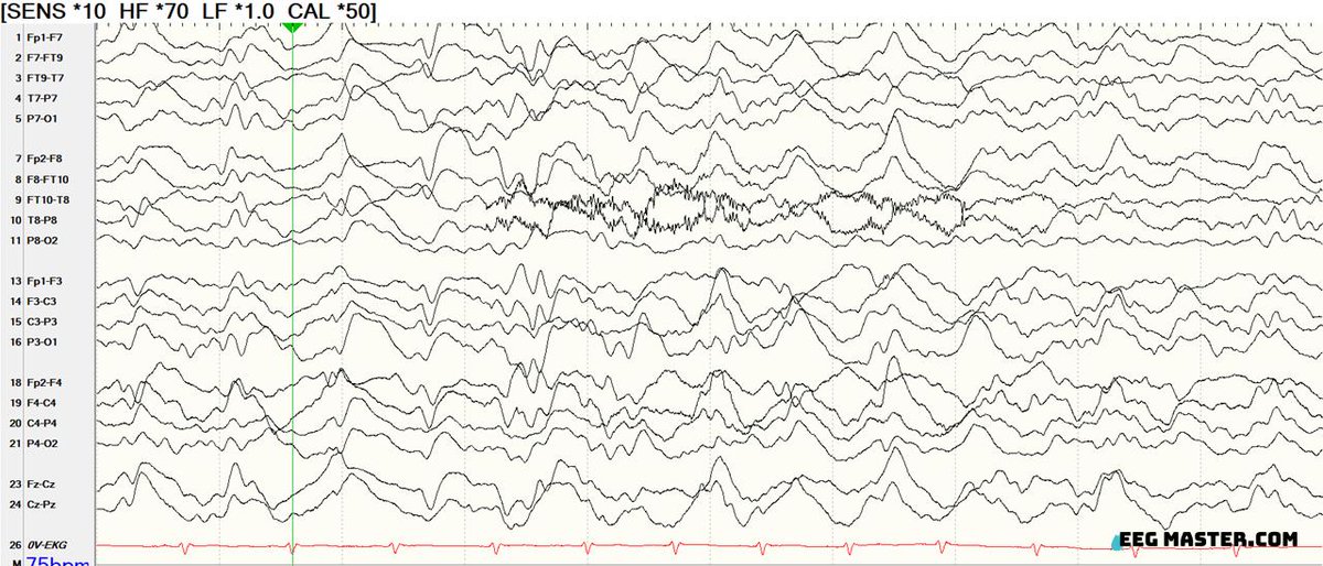 Which of the following is correct regarding the sleep stage shown in the EEG below?
Select your answer and read the explanation at eegmaster.com/eegmaster/quiz…