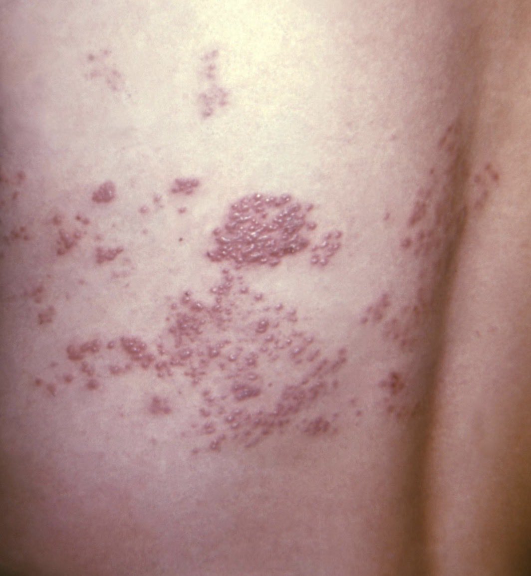 💥The shingles vaccine might be one of the most underrated health moves after 50.💥

New large study(174K pts):
▪️ 50% lower risk of vascular dementia
▪️ 27% fewer blood clots
▪️ 25% lower risk of heart attack or stroke
▪️ 21% lower risk of dying early

Not just about the rash —