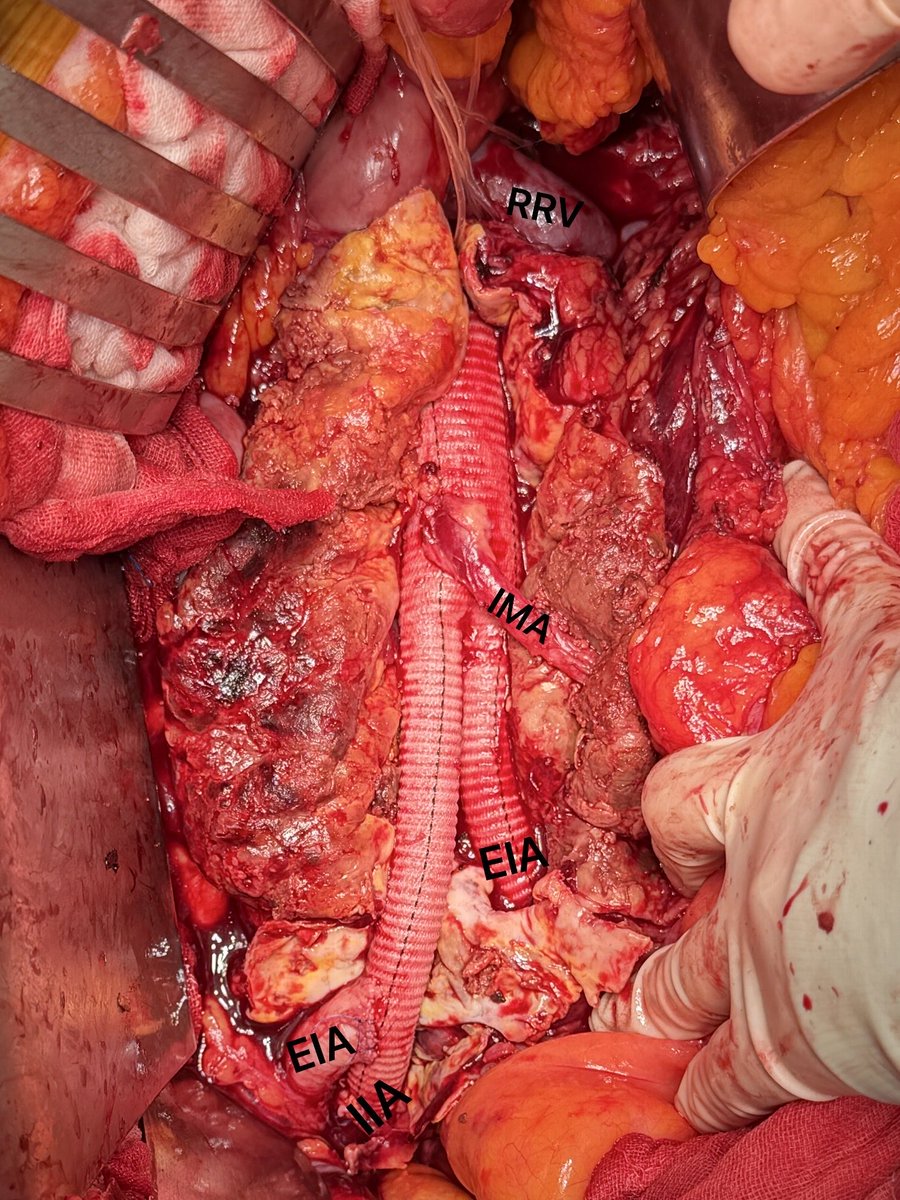 Robust, Reliable, and Cost-Effective Repair for Juxtarenal AAA #AAA #AortaEd