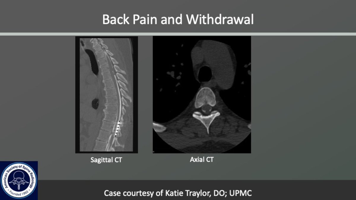 The_ASSR's tweet image. ASSR COTW

History: Back Pain &amp;amp; Withdrawal

Case c/o @KatieTraylorDO @PittRadiology 

#SpineRad #NeuroRad #MedEd #FOAMed #FOAMrad #neuroradiology #radiology