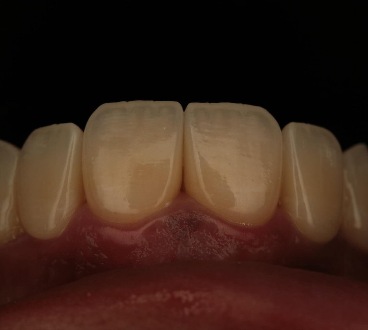 حالة تجميلية متقدمة تضمنت:
🔹 استبدال الأسنان المفقودة ب #زراعة مُخططة رقميًا. 
🔹 تصميم ابتسامة رقمية (Digital Smile Design) لتحقيق تناسق مثالي مع ملامح الوجه
🔹 قشور خزفية #فينيرز لتوحيد اللون والشكل والحيوية

النتيجة: ابتسامة طبيعية تنسجم مع ملامح الوجه وتُعبّر عن شخصية