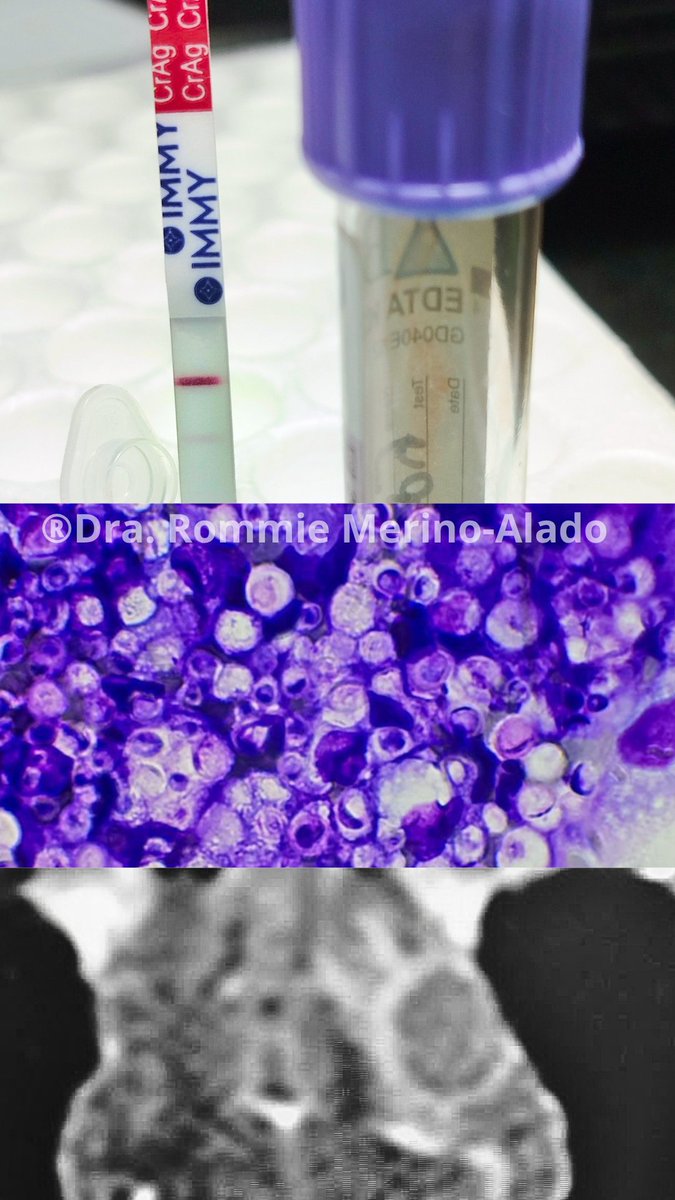 Unresponsive disseminated Cryptococcosis in a feline patient. Brain mass, mediastinal enlarged nodes, 2 days of fluconazole and new cutaneous+occular lesions appeared laing with positive LFA. Lung and brain biopsies positive for cryptococcoma