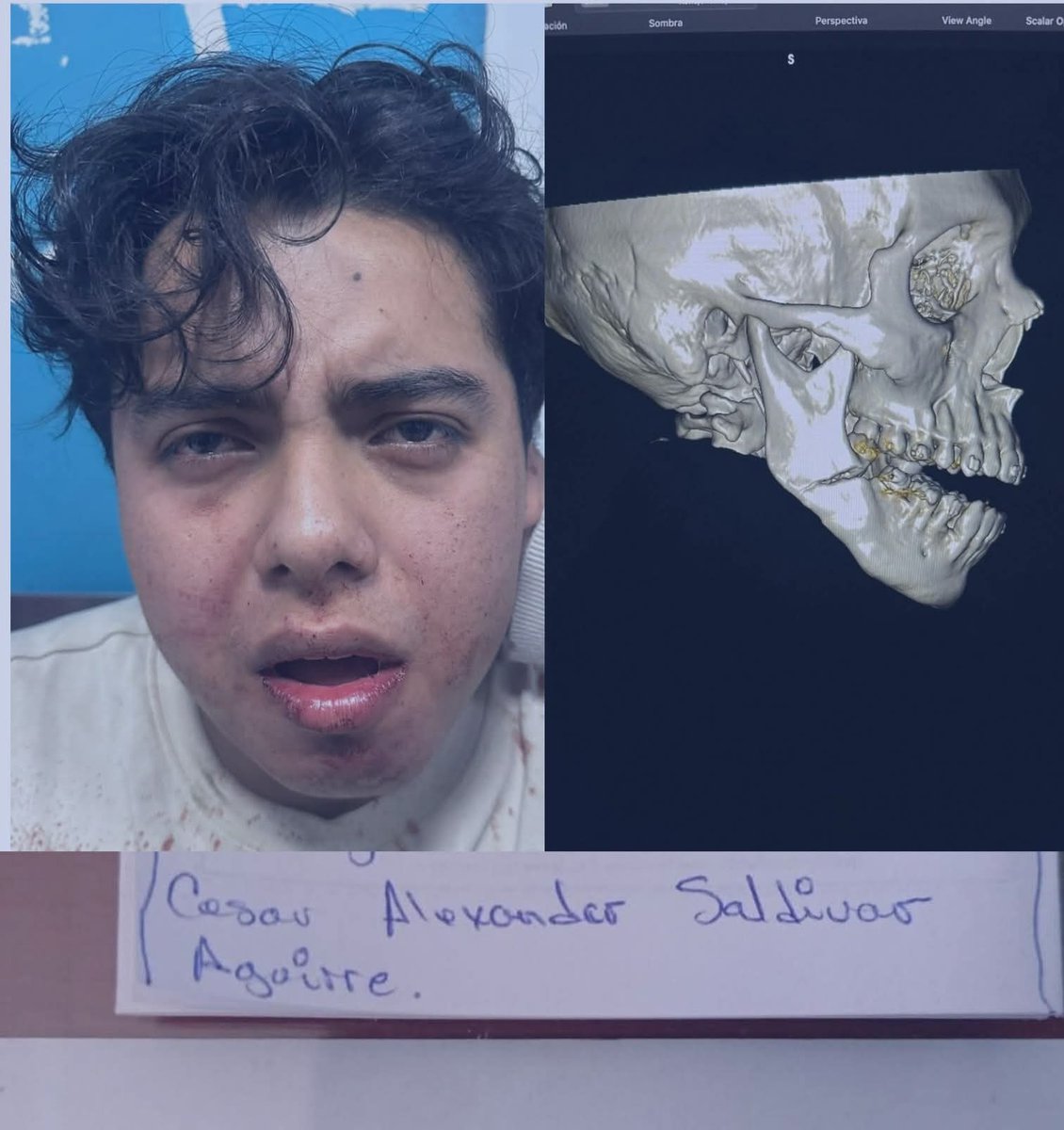 _MoisesRivera_'s tweet photo. #DenunciaCiudadana

Cesar Saldivar, desde anoche no ha sido atendido en el Hospital Zacamil, tras haber sido herido en un asalto, dónde resultó con la mandíbula fracturada

No hay camillas, ni medicamentos disponibles para atenderlo

Enlace de denuncia👇
https://t.co/B7gsJ6Sni1 https://t.co/mW6vpxrpMl