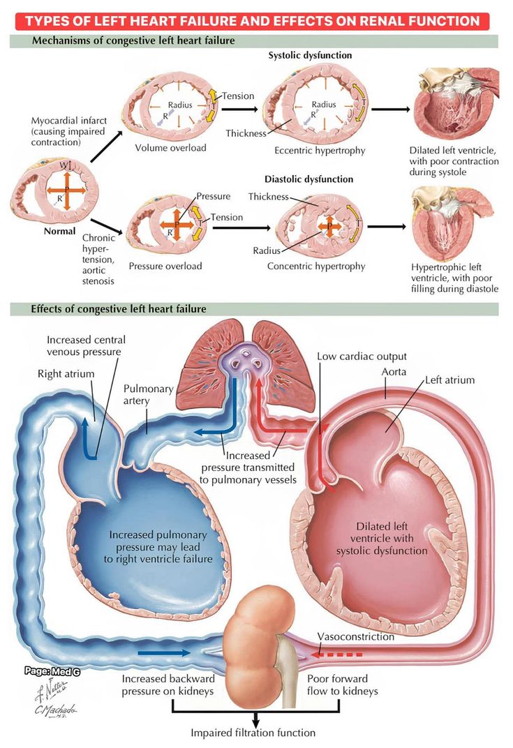 drsthanus's tweet photo. The types of left heart failure and their effects on renal function.

https://t.co/JL2ZLIZh73 https://t.co/dVKM1rV93U