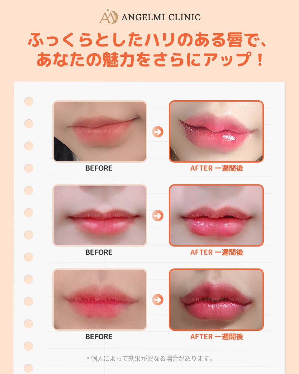 angelmiclinic's tweet image. ✨ボリュームリップ✨
笑顔がもっと愛らしくなる瞬間、
唇全体フィラー 👄
▶️ 97,900ウォン（税込）

#ふっくら唇 
#ボリュームリップ 
#口角アップ

エンジェルミ医院では、
豊富な経験と繊細な技術をもとに、
お顔のバランスに合わせたパーソナルデザインをご提案。 🧑🏻‍⚕️👩🏻‍⚕️…