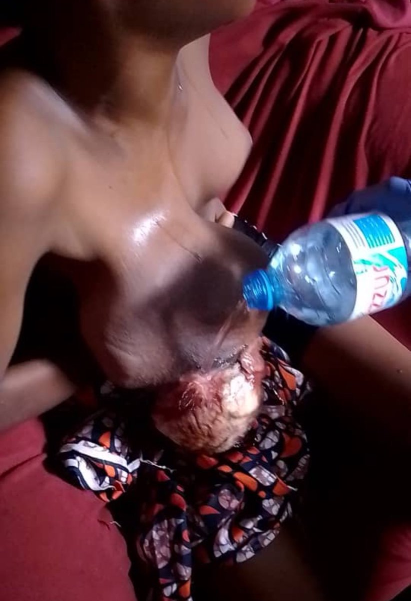 FellyMbula3's tweet photo. 🆘🆘APPEL URGENT À L’AIDE MÉDICALE ET HUMANITAIRE.

📍Identification de la Patiente :

• Patiente : S.
• Sexe : Féminin
• Âge : 13 ans
• Statut scolaire : Élève en 7ème
• Contexte socio-économique : Famille démunie, sans couverture financière pour les soins.
• Localisation actuelle : Kinshasa (arrivée récente, sans structure d'accueil ni prise en charge médicale établie).

🛑🛑ANAMNÈSE ET HISTORIQUE DE LA PATHOLOGIE.

📌La symptomatologie a débuté il y a environ un an à la suite d'un traumatisme direct du sein droit par morsure humaine, survenu lors d'une altercation familiale.

📌Initialement, les lésions cutanées superficielles (marques dentaires) ont été traitées de manière traditionnelle. 

📌L'évolution clinique a été marquée par une dégradation progressive :

1. Augmentation de volume progressive du sein droit (macro-mammaire unilatérale).

2. Apparition d'un écoulement purulent franc au niveau de la zone traumatisée.

📌Ce tableau clinique est hautement suggestif d'une infection chronique profonde (type abcès ou mastite septique) compliquant le traumatisme initial.

🛑🛑 PRISE EN CHARGE ANTÉRIEURE ET TRANSFERT.

📍Face à l'aggravation des symptômes, la patiente a consulté à l'Hôpital Général de Référence (HGR) de Kikwit. En raison de la complexité du cas et/ou du besoin de ressources spécialisées non disponibles localement, un transfert médical a été organisé vers Kinshasa pour une meilleure prise en charge spécialisée (potentiellement en chirurgie ou en infectiologie).

🛑🛑 SITUATION ACTUELLE ET URGENCE VITALE

📌Actuellement, la patiente est bloquée à la maison. 

📌L'absence de soutien financier et de prise en charge institutionnelle immédiate met sa vie en danger. 

📌L'état clinique, marqué par un écoulement purulent chronique et une masse au sein droit, nécessite une hospitalisation urgente.

📌Chaque heure est critique pour la survie de cette petite fille et la prévention de complications potentiellement septiques et dévitalisantes.

🆘🆘 CONTACTS POUR ASSISTANCE.

📌Les personnes, structures hospitalières ou organisations humanitaires souhaitant apporter un soutien financier ou une aide à l'orientation et à la prise en charge médicale sont priées de contacter :
• +243 851 794 500
• +243 998 347 345

Fait à Kinshasa, le 22/10/2025 à 08h10’

Dr Bakandi Mbula Felly