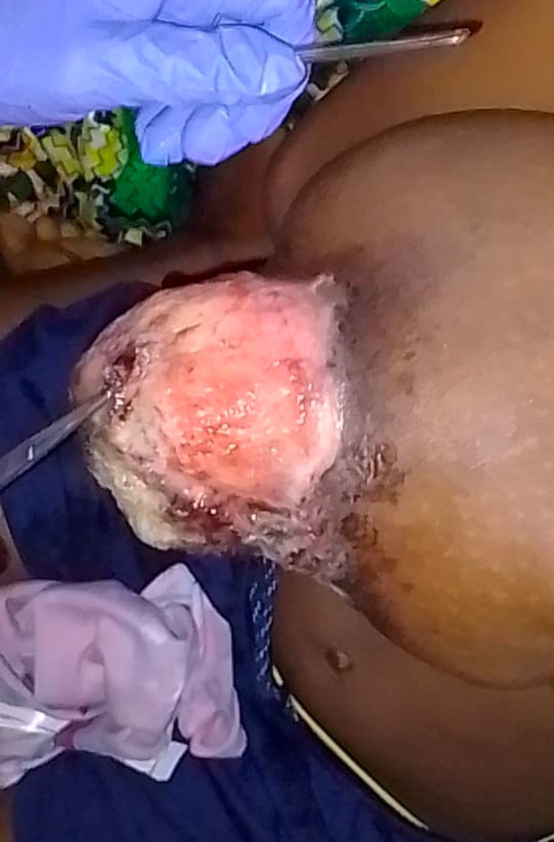 FellyMbula3's tweet photo. 🆘🆘APPEL URGENT À L’AIDE MÉDICALE ET HUMANITAIRE.

📍Identification de la Patiente :

• Patiente : S.
• Sexe : Féminin
• Âge : 13 ans
• Statut scolaire : Élève en 7ème
• Contexte socio-économique : Famille démunie, sans couverture financière pour les soins.
• Localisation actuelle : Kinshasa (arrivée récente, sans structure d'accueil ni prise en charge médicale établie).

🛑🛑ANAMNÈSE ET HISTORIQUE DE LA PATHOLOGIE.

📌La symptomatologie a débuté il y a environ un an à la suite d'un traumatisme direct du sein droit par morsure humaine, survenu lors d'une altercation familiale.

📌Initialement, les lésions cutanées superficielles (marques dentaires) ont été traitées de manière traditionnelle. 

📌L'évolution clinique a été marquée par une dégradation progressive :

1. Augmentation de volume progressive du sein droit (macro-mammaire unilatérale).

2. Apparition d'un écoulement purulent franc au niveau de la zone traumatisée.

📌Ce tableau clinique est hautement suggestif d'une infection chronique profonde (type abcès ou mastite septique) compliquant le traumatisme initial.

🛑🛑 PRISE EN CHARGE ANTÉRIEURE ET TRANSFERT.

📍Face à l'aggravation des symptômes, la patiente a consulté à l'Hôpital Général de Référence (HGR) de Kikwit. En raison de la complexité du cas et/ou du besoin de ressources spécialisées non disponibles localement, un transfert médical a été organisé vers Kinshasa pour une meilleure prise en charge spécialisée (potentiellement en chirurgie ou en infectiologie).

🛑🛑 SITUATION ACTUELLE ET URGENCE VITALE

📌Actuellement, la patiente est bloquée à la maison. 

📌L'absence de soutien financier et de prise en charge institutionnelle immédiate met sa vie en danger. 

📌L'état clinique, marqué par un écoulement purulent chronique et une masse au sein droit, nécessite une hospitalisation urgente.

📌Chaque heure est critique pour la survie de cette petite fille et la prévention de complications potentiellement septiques et dévitalisantes.

🆘🆘 CONTACTS POUR ASSISTANCE.

📌Les personnes, structures hospitalières ou organisations humanitaires souhaitant apporter un soutien financier ou une aide à l'orientation et à la prise en charge médicale sont priées de contacter :
• +243 851 794 500
• +243 998 347 345

Fait à Kinshasa, le 22/10/2025 à 08h10’

Dr Bakandi Mbula Felly