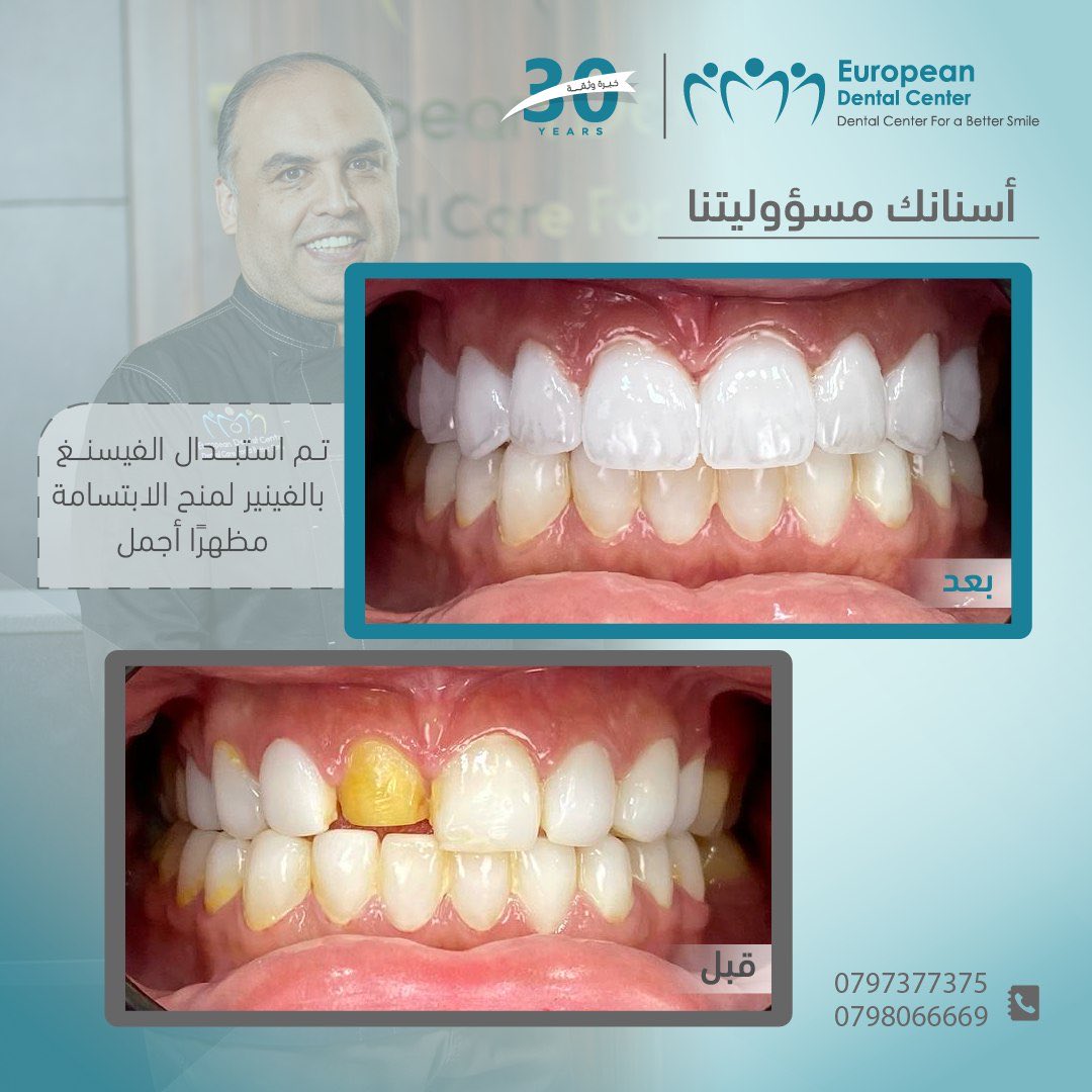 mohanadskiswani's tweet image. تم استبدال الفيسنغ بالفينير لمنح الابتسامة مظهرًا أجمل وأكثر إشراقًا

المركز الأوروبي لطب الأسنان 30 عامًا من الخبرة في زراعة وتجميل الأسنان متخصصين في الحالات الحرجة

حاصل على اعتمادية تيموس في الجودة والكفاءة المهنية والطبية لست سنوات على التوالي (2015-2021)

احجز موعد استشارتك…