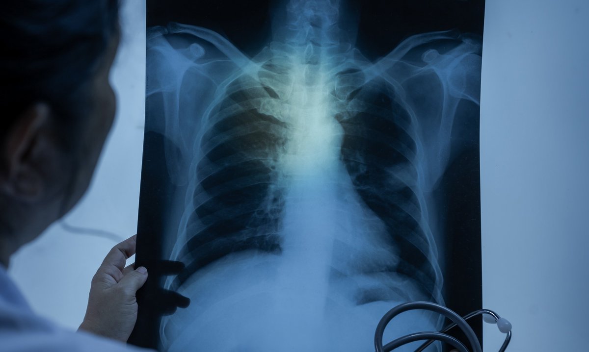 AZoSensors's tweet image. 🧬 Scientists show aluminum nitride nanotubes may help spot lung cancer through breath, offering a faster, noninvasive diagnosis. Their computational modelling will now be translated to the lab! azosensors.com/news.aspx?news… #Nanotechnology #LungCancer #AZoSensors