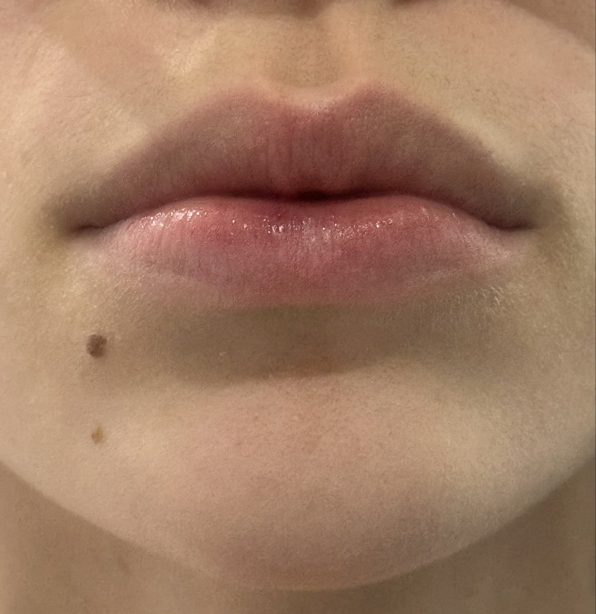v4in_ak1's tweet image. anyone else feel lik their lips got bigger after losing weight 
2024 vs now