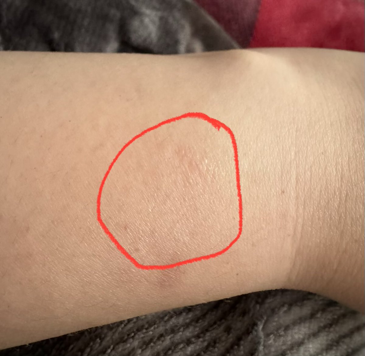 MissMonique_M's tweet photo. @iDeviceHelpus Mine is healing now, however I had the same issue. I’ve never had this in the past with my Apple Watches, is only since I got the Apple Watch 11. I’ve changed the wrist now and I’ll keep an eye. Is very strange. https://t.co/ixgDijinML