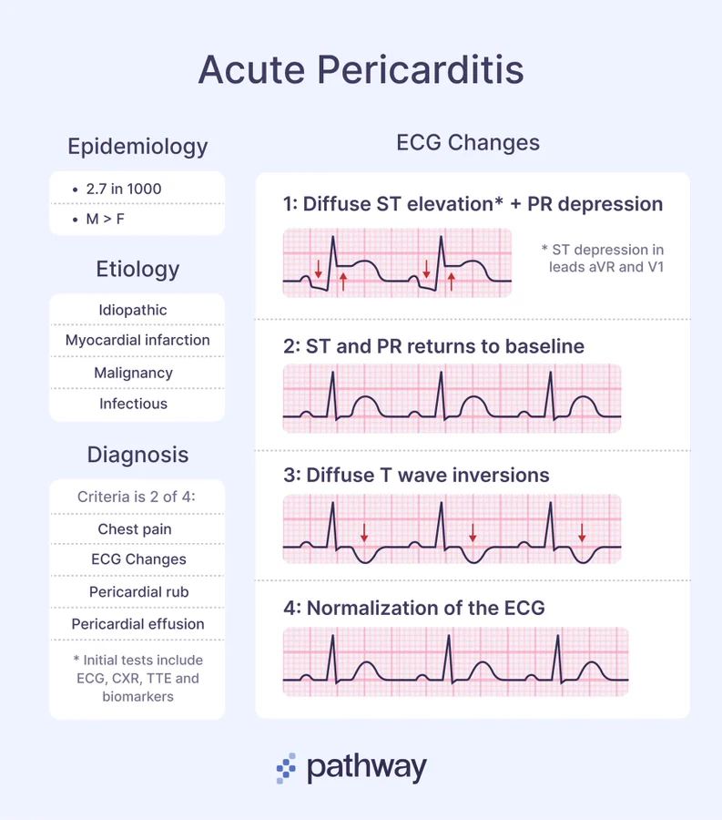 Acute Pericarditis : Inflammation of the pericardium, often presenting with pleuritic chest pain &amp; characteristic ECG changes.

Etiology: Idiopathic, MI, malignancy, infections.
Diagnosis (≥2/4): Chest pain, ECG changes, pericardial rub, effusion.

ECG Progression:
1️⃣ Diffuse ST