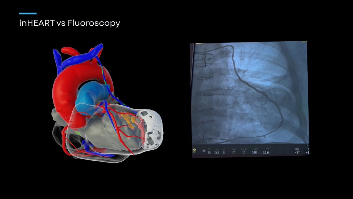The first @inHEART X <a href="/remedesystem/">ZOLL Respicardia</a> Implant procedure! Successfully performed by Dr. Martin Espinosa, this procedure delivers phrenic nerve stimulation to restore normal breathing in a patient affected by sleep apnea.

We’re proud to support the dedicated team at Sarasota Memorial