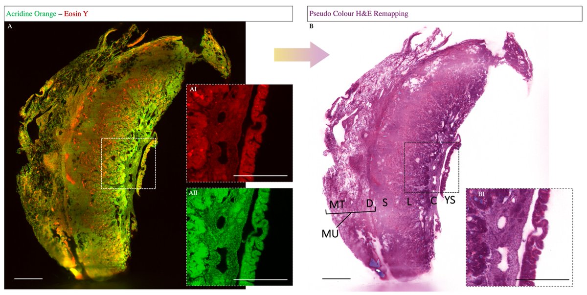 Biomol_MDPI's tweet image. #HighlyAccessedPaper

&quot;Three-Dimensional Histological Characterization of the Placental Vasculature Using Light Sheet Microscopy&quot; by Lennart Freise, et al.

Cited 3 times | Viewed 3797 times.

Read now ➡️ brnw.ch/21wWPQ6

#LightSheet #Placenta #Preeclampsia #Vascular