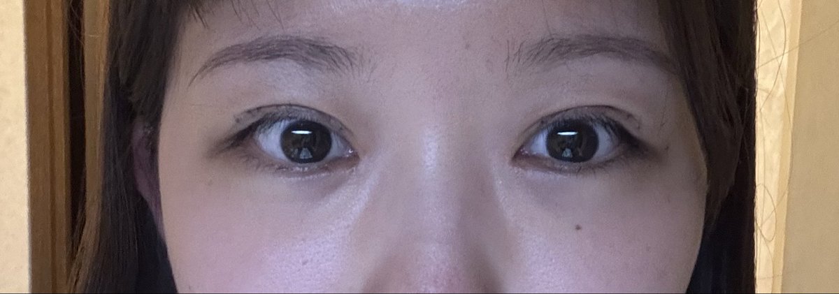 naaaa____naaa's tweet photo. 二重全切開+眼瞼下垂（保険適応）DT 9日目（抜糸前）
糸がまぶたに刺さってちくちくするし痒い
→側の目尻側が二重じゃなくなってる😭😭
腫れが引いたら二重に戻るのかな〜 https://t.co/V1xZkZqB6u