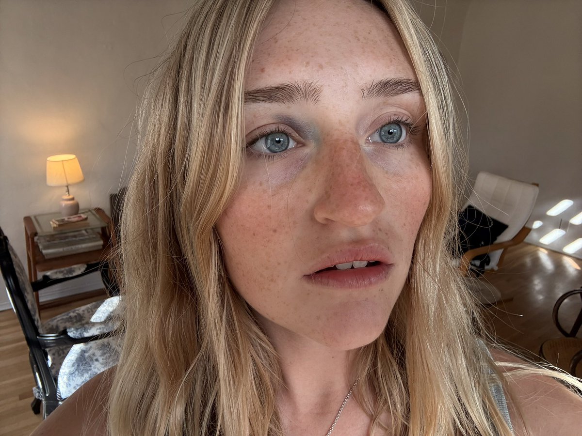 deafandblinddog's tweet photo. Progress photos of the black eye I mysteriously woke up with after the Addison Tour #raecist https://t.co/dGXUj92VBO