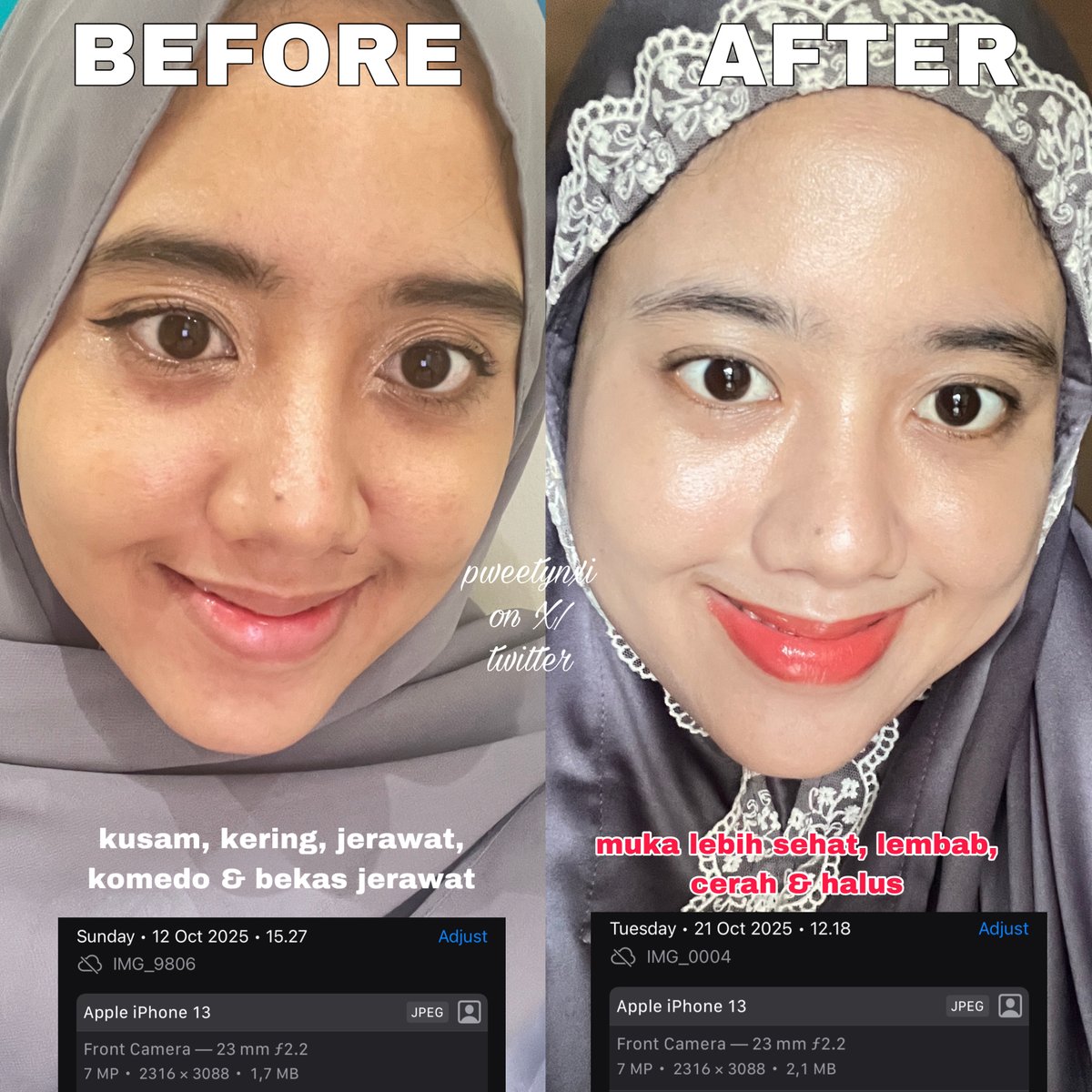 THE POWER OF PICO LASER ✨

Ga akan pernah nyesel decide untuk treatment ini mumpung harganya masih ramah dikantong 👏🏻
