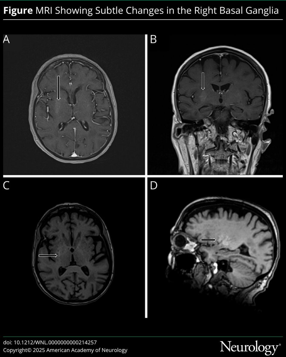 GreenJournal's tweet image. This Video #NeuroImage highlights a case of hemichorea associated with euglycemic diabetic ketoacidosis. Video and case at link: hubs.la/Q03P9bft0