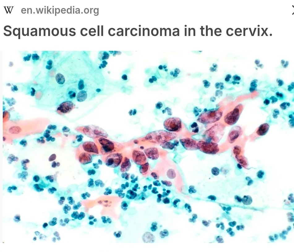Subhash_LiveS's tweet photo. 1/2.Think about #CervicalCancer
#PapSmears can feel awkward, but don't postpone a visit to your doctor.
Screening is desirable. Cervical cancer, if detected early, treatable. https://t.co/8pFCawS9jA