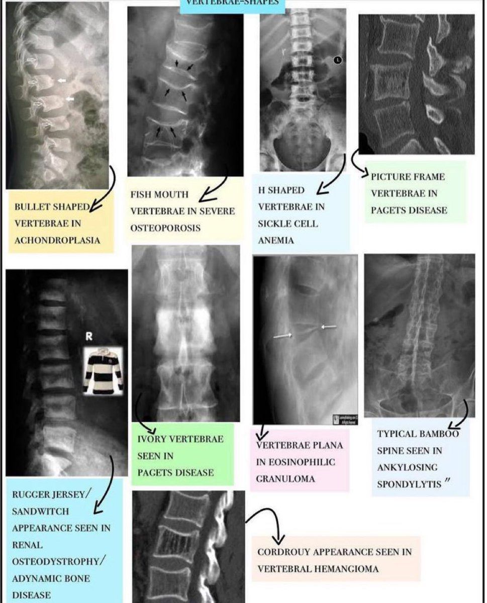 MoAImam's tweet image. Vertebral spine problems