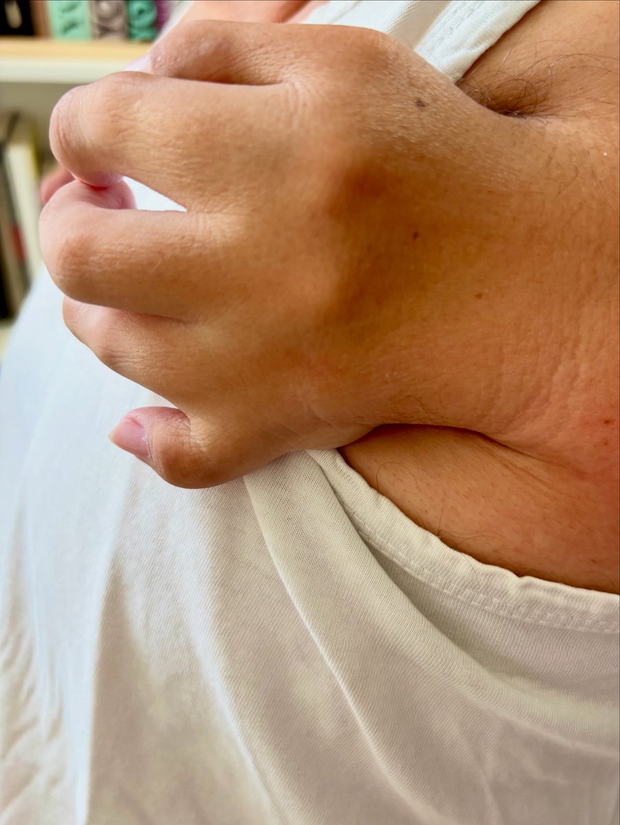 Esta es mi mano, la que se ve cuando bebo agua, cuando escribo o cuando hago terapia. Es la misma que ven las personas que me consultan al otro lado de la pantalla.

La discapacidad no desaparece cuando uno trabaja como psicólogo