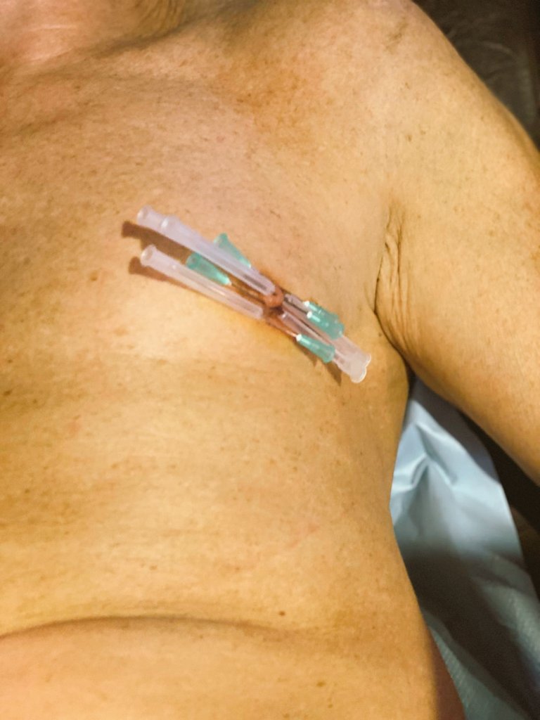 Séance d'aiguilles de Maîtresse Sow Sarah de la Forge.