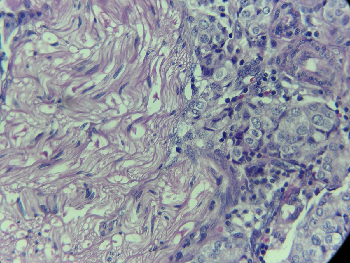 DrRamirezPath's tweet photo. Breast cancer: Perineural invasion https://t.co/N6pPbUc4aT