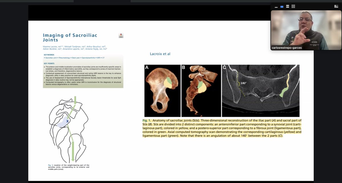 pios_institute's tweet photo. La #disfuncion #sacroiliaca sigue siendo un tema de difícil #diagnostico y con este #curso se han expuesto todos los tips para la orientación clínica, diagnóstico diferencial y los diferentes abordajes de #bloqueo y #RF . Gracias Aldo Ortiz, Carlos Restrepo y JM Trinidad por su profesionalidad, y a @Abbott por seguir apoyando a este proyecto