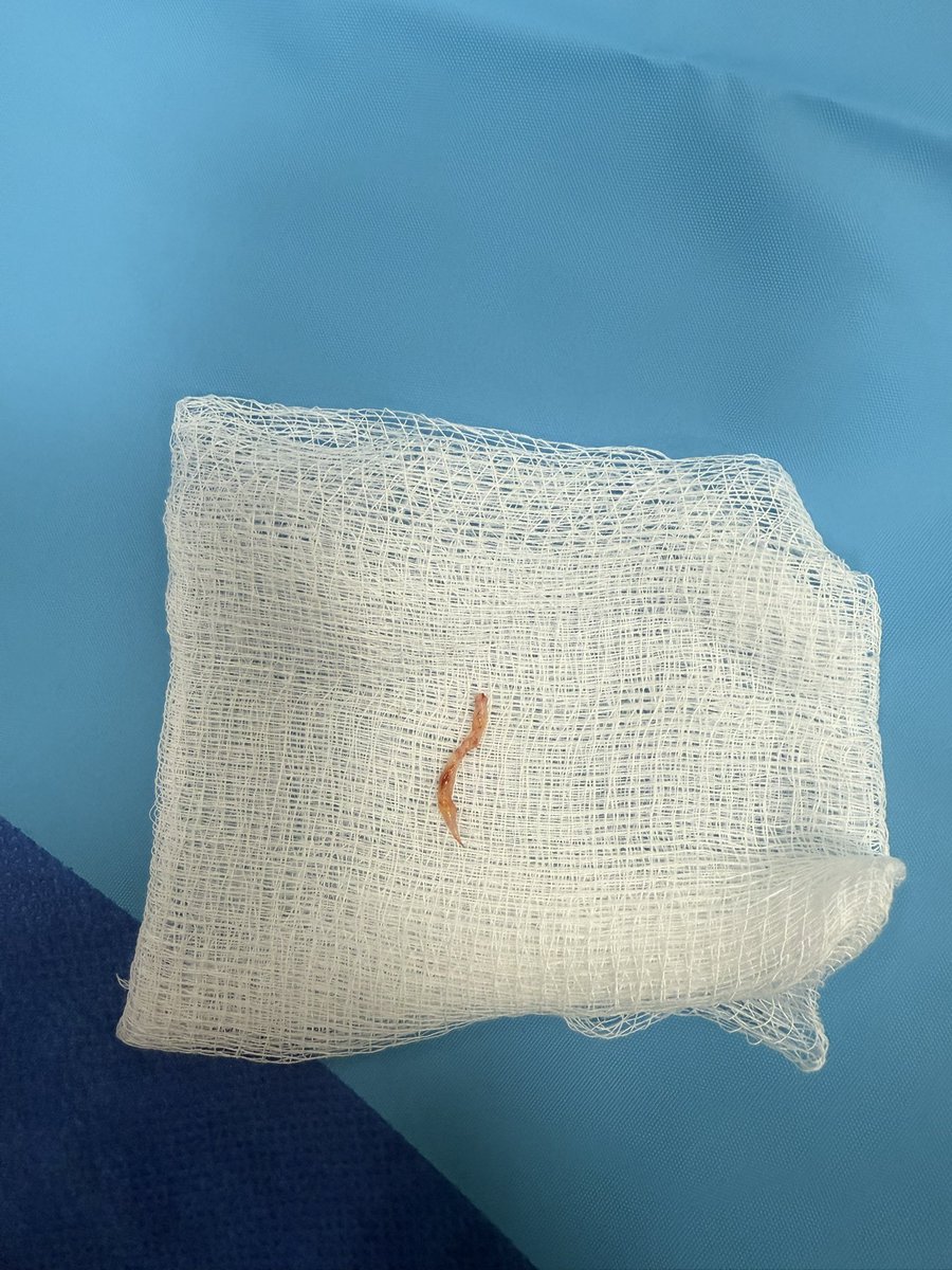 NaderElSeblani's tweet photo. 🚨 Basilar stroke with life-saving thrombectomy!
LKW 4 hrs
Trevo stent retriever captured large plaque burden — achieved TICI 3 reperfusion 🧠💥
Patient recovered with only mild right arm weakness.
Time is brain — and flow is life! 💪
#Stroke 
#NeuroEndovascularSurgery #SVIN https://t.co/WnqPzKSGcu