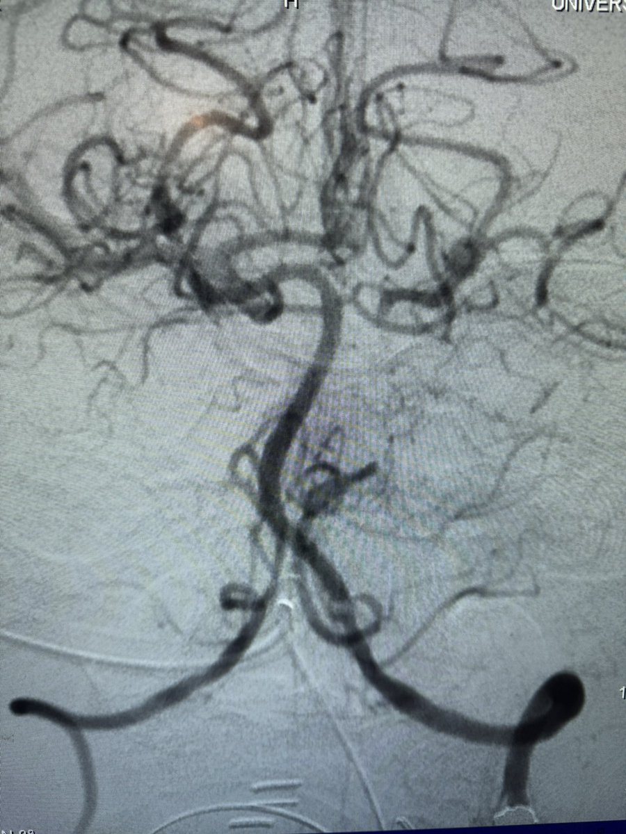 NaderElSeblani's tweet photo. 🚨 Basilar stroke with life-saving thrombectomy!
LKW 4 hrs
Trevo stent retriever captured large plaque burden — achieved TICI 3 reperfusion 🧠💥
Patient recovered with only mild right arm weakness.
Time is brain — and flow is life! 💪
#Stroke 
#NeuroEndovascularSurgery #SVIN https://t.co/WnqPzKSGcu