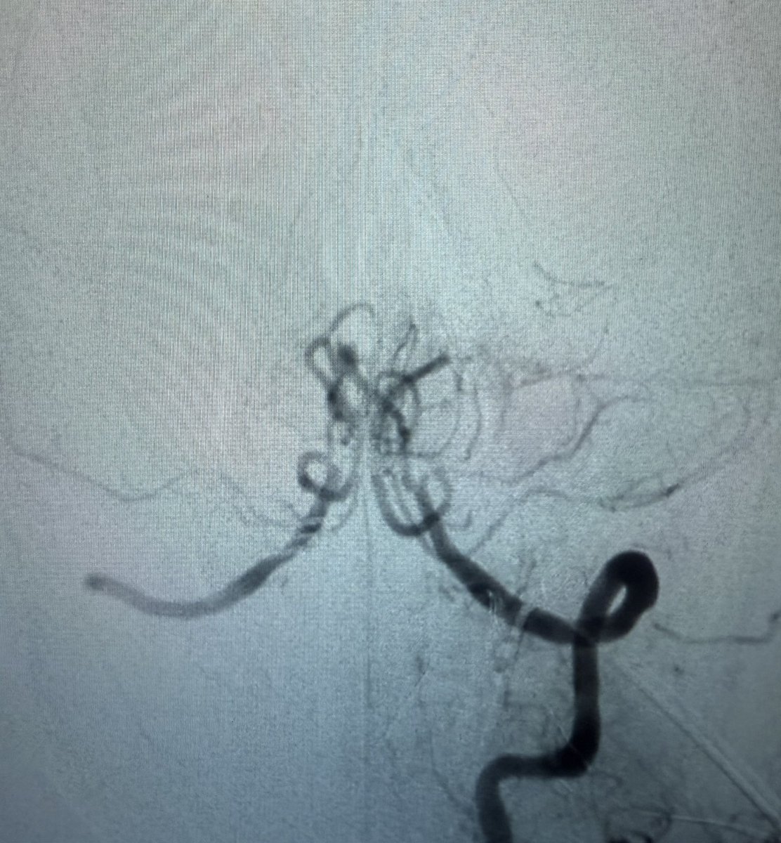 NaderElSeblani's tweet photo. 🚨 Basilar stroke with life-saving thrombectomy!
LKW 4 hrs
Trevo stent retriever captured large plaque burden — achieved TICI 3 reperfusion 🧠💥
Patient recovered with only mild right arm weakness.
Time is brain — and flow is life! 💪
#Stroke 
#NeuroEndovascularSurgery #SVIN https://t.co/WnqPzKSGcu
